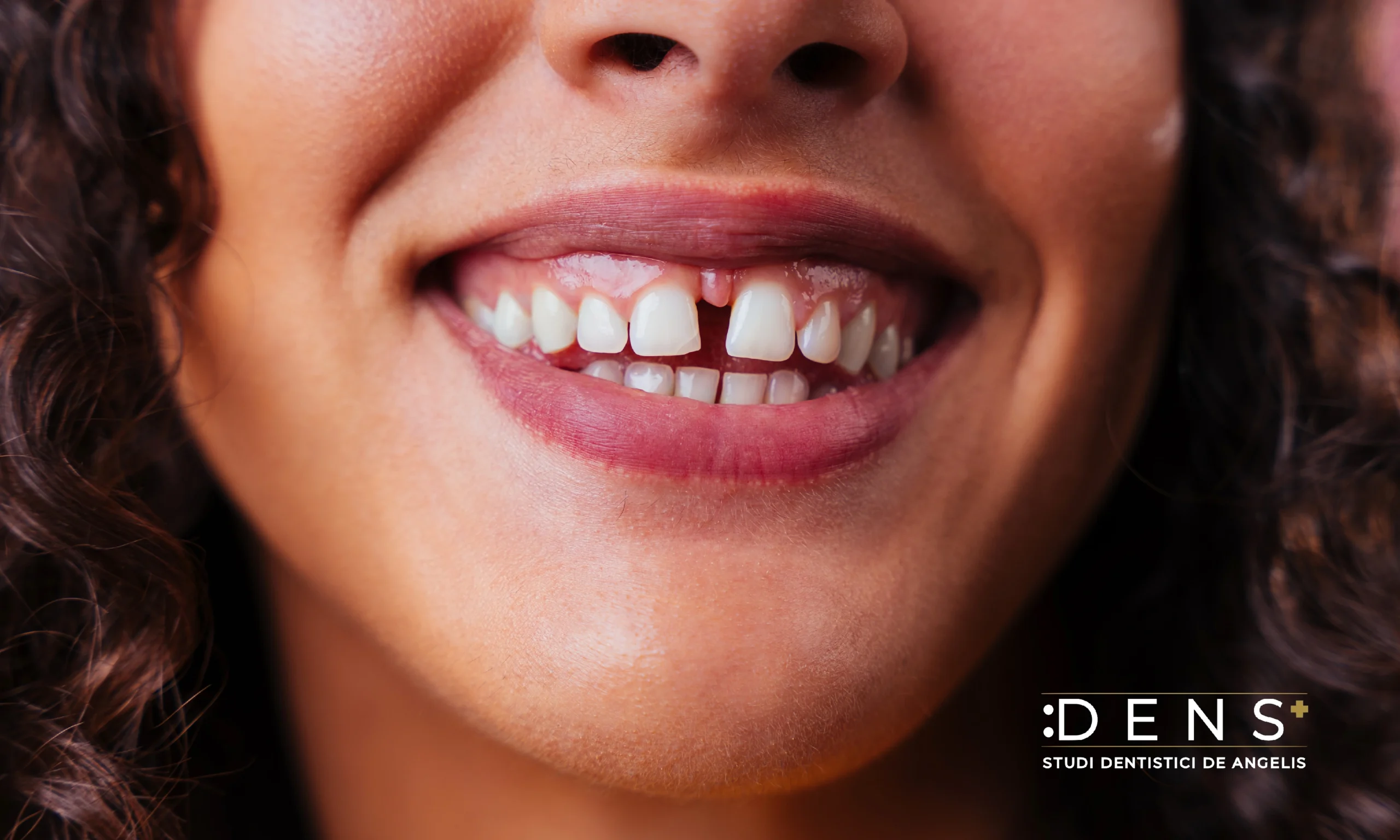 diastema dentale tra incisivi centrali superiori