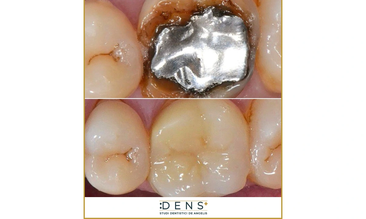 confronto tra amalgama dentale e otturazione in composito dopo rimozione amalgama
