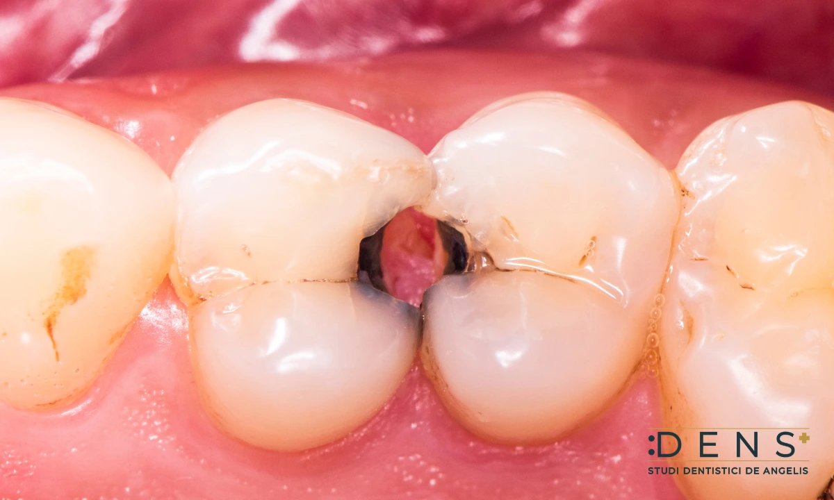 carie dentale su un molare con perdita di tessuto dentale